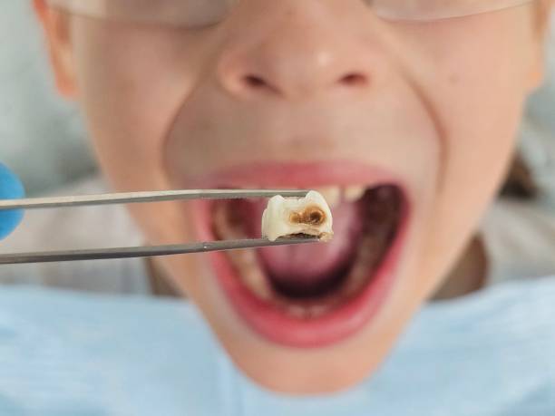 Best Emergency Wisdom Tooth Extraction in Lahaina, HI